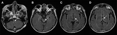 Vestibular Dysfunction in Wernicke’s Encephalopathy: Predominant Impairment of the Horizontal Semicircular Canals